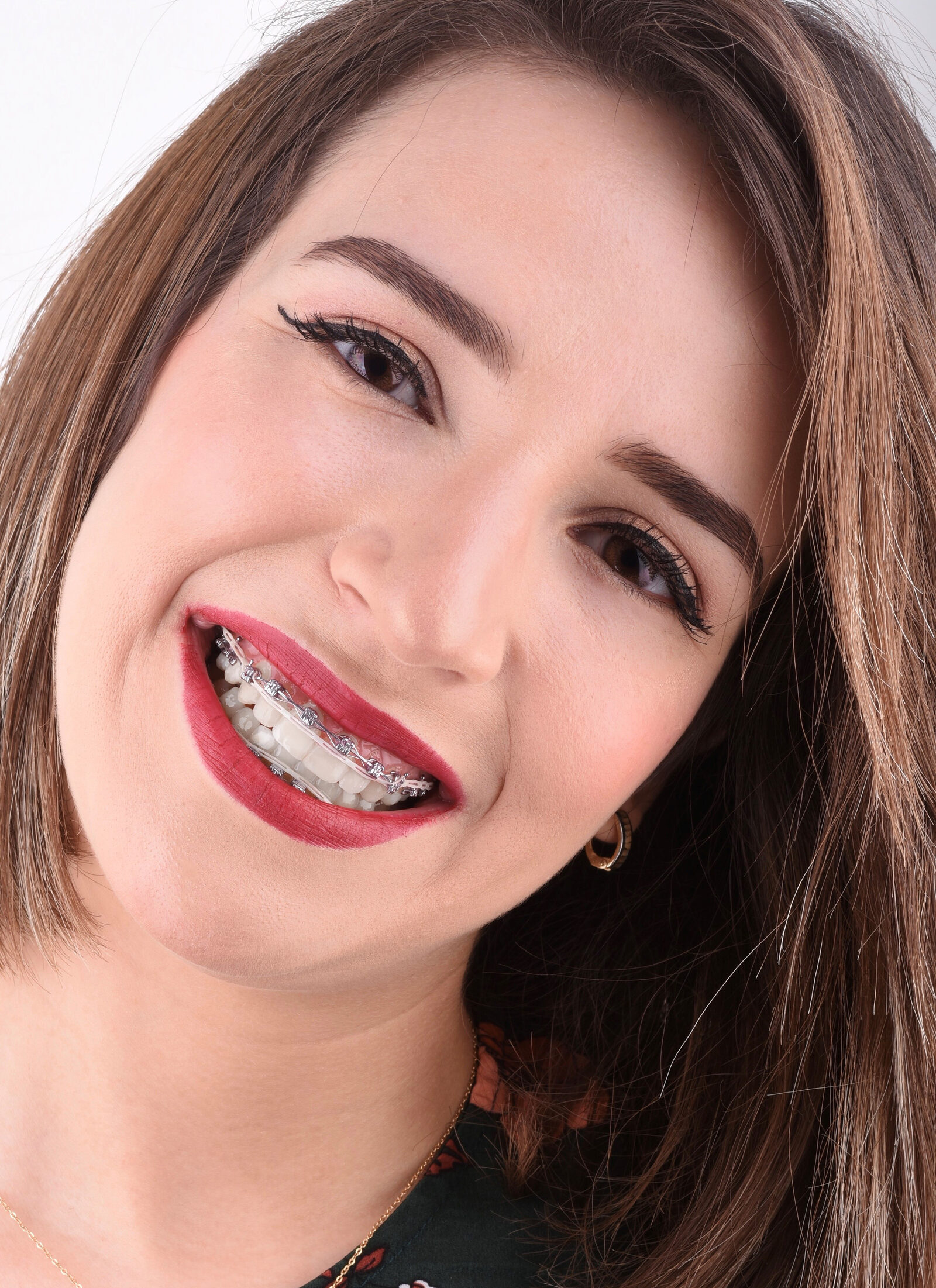 Patient with Pitts21 PRO brackets visible while smiling