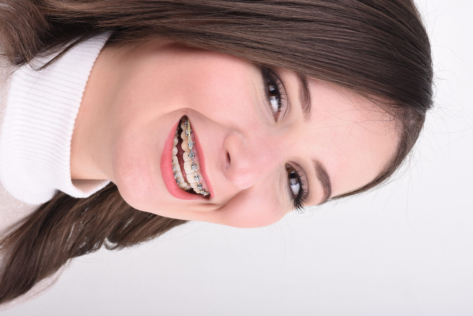 Mid-treatment view of a patient with Pitts21 PRO brackets and elastics
