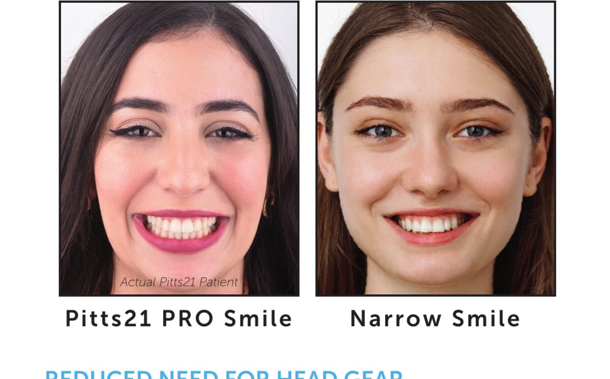 Side-by-side comparison of a wide Pitts21 PRO smile arc on the left and a narrow smile from traditional treatment on the right