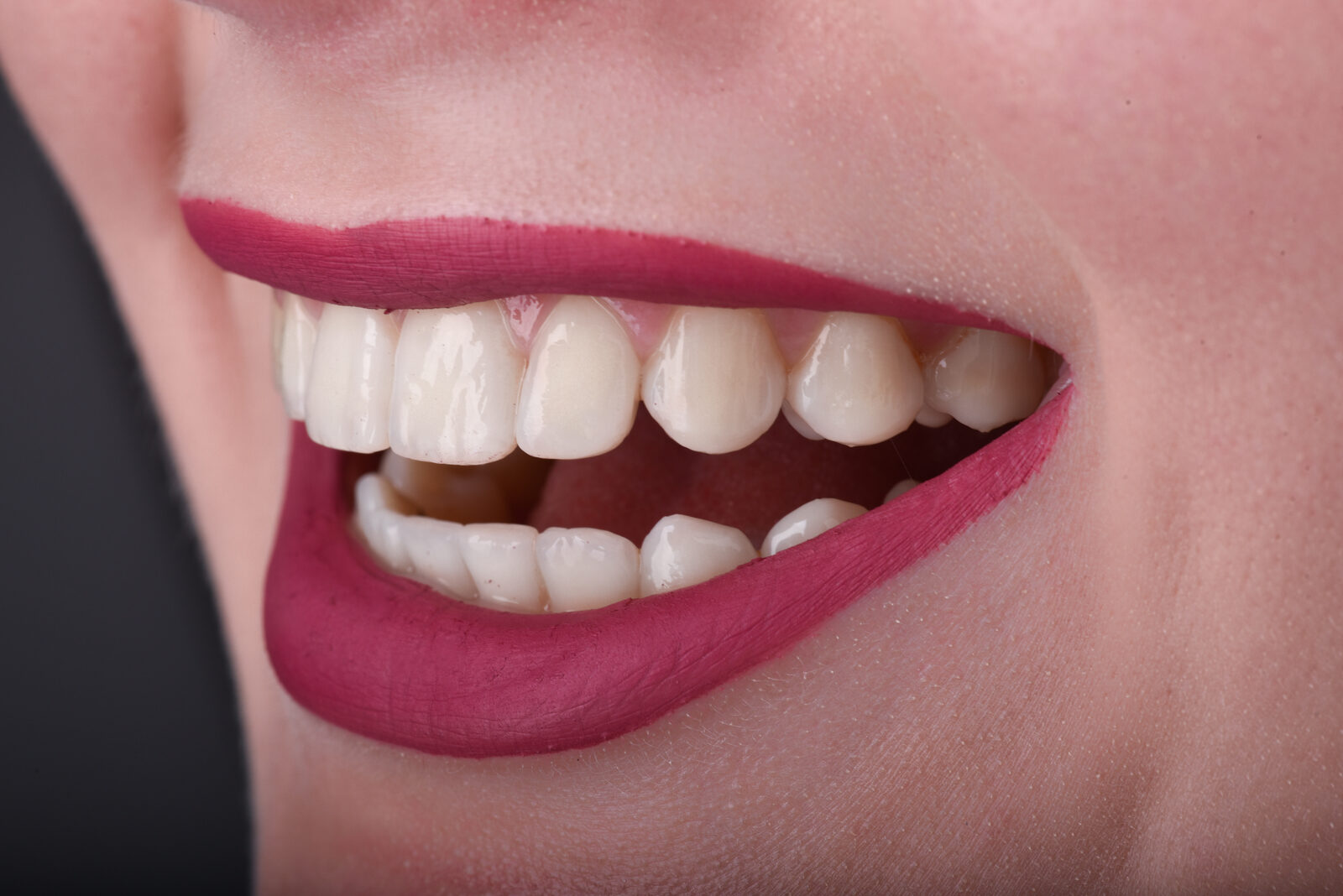 Close-up of a patient's bright, finished smile after Pitts21 PRO treatment
